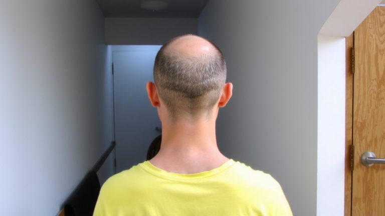 tennis ball suboccipital decompression